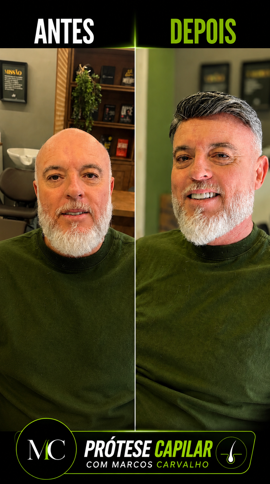 Transformação antes e depois com prótese capilar — resultado 3