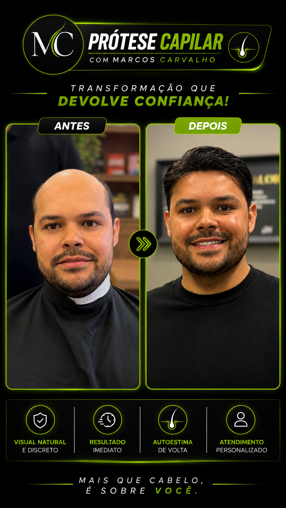 Transformação antes e depois com prótese capilar — resultado 4