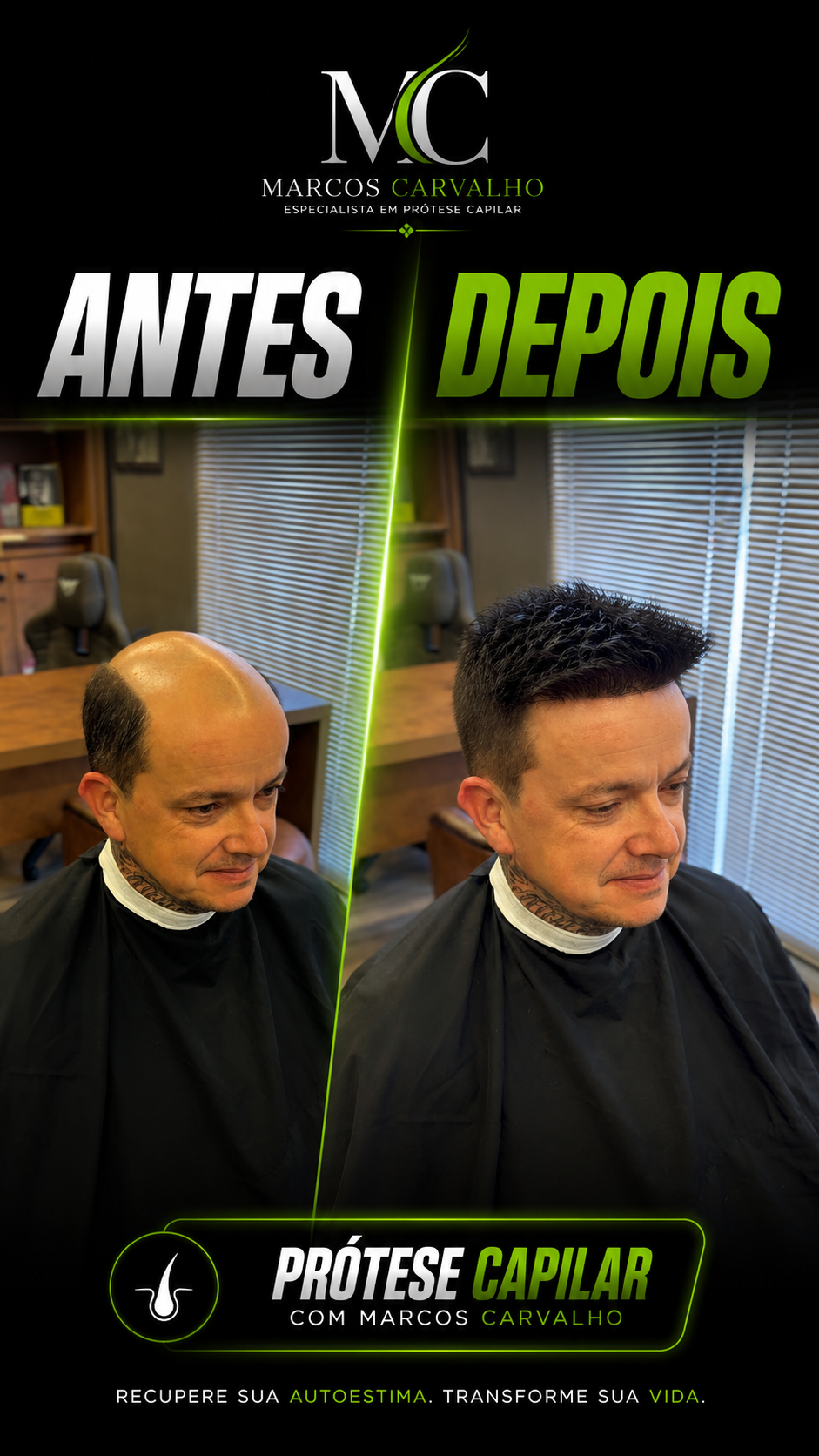 Transformação antes e depois com prótese capilar — resultado 6